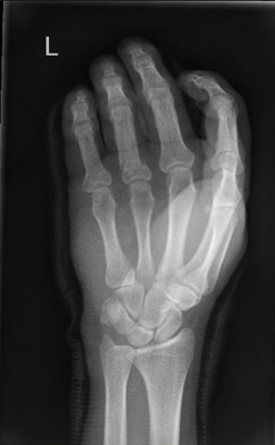 x-ray-after-setting-in-cast-zoomed.png